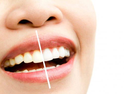 ¿Qué es un blanqueamiento dental?