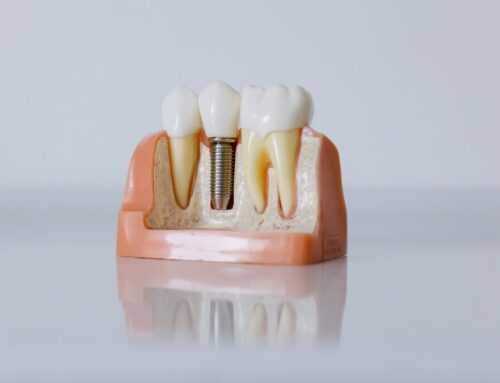 Implantes con carga inmediata o dientes en un día. ¡Estrena sonrisa en 24 horas!